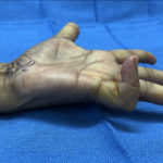 Several years of Dupuytren’s contracture of the small finger and loss of function is quickly and painlessly corrected with a Needle Aponeurotomy Procedure. Photo from Dr. Raskin